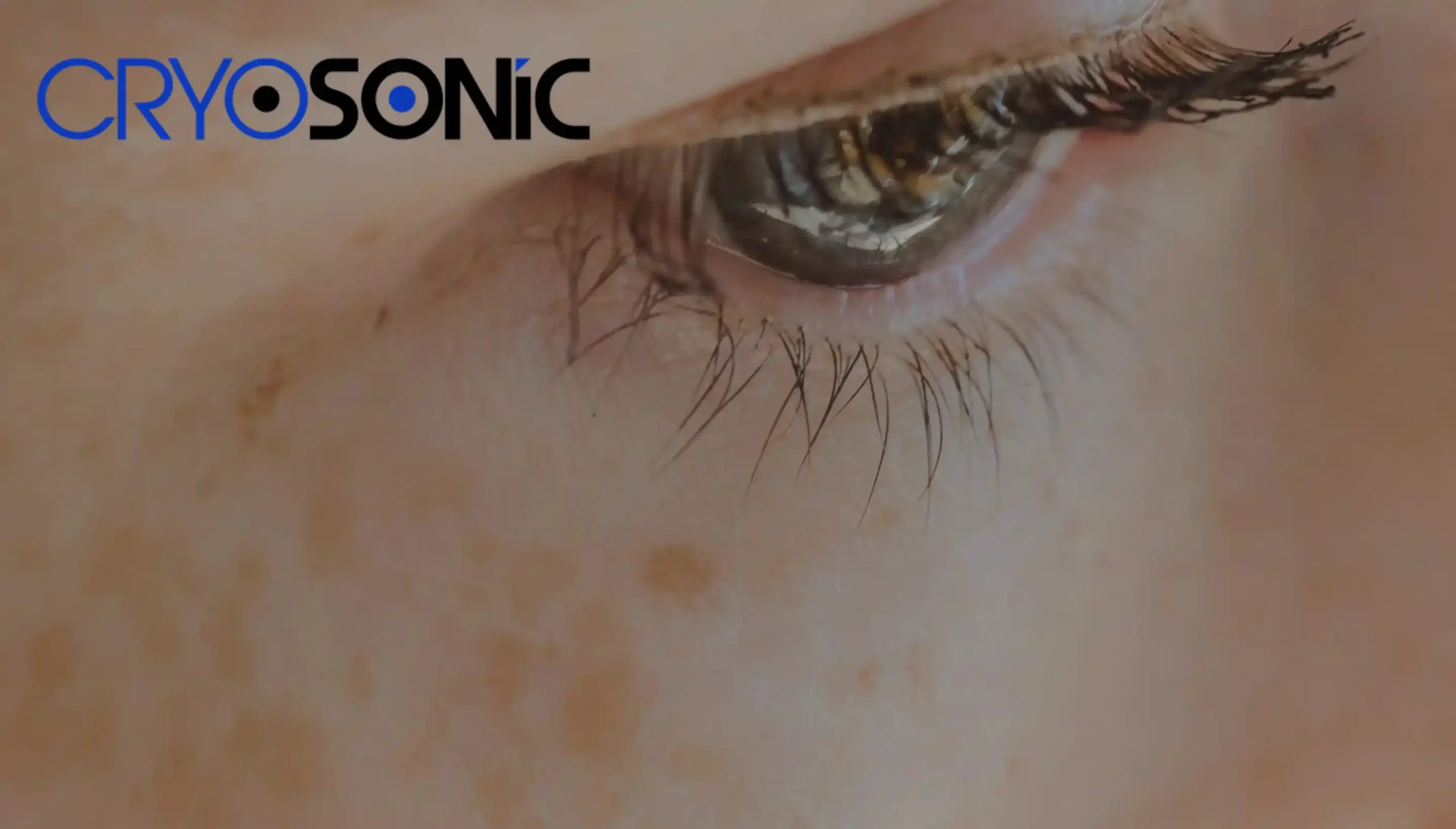 How To Get Rid of Sun Spots Around The Eyes Birmingham